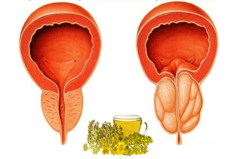 Healthy and bad prostate