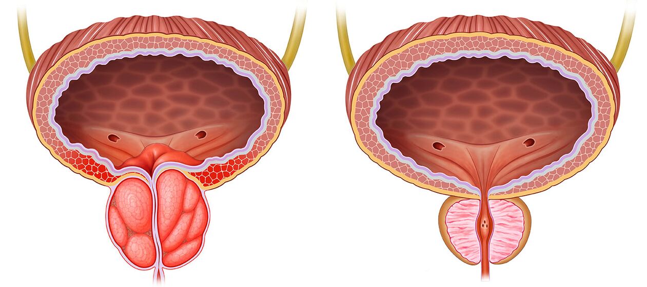 inflamed and healthy prostate after using Predstonorm capsules